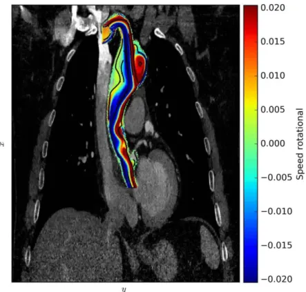 Figure  III.1  –  Illustrative  computation  of  blood  flow  through  an  aortic  aneurysm  from  medical image