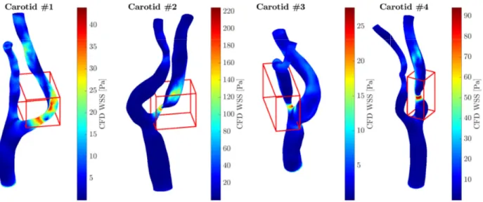 Figure 3: WSS magnitude obtained by CFD simulation over four carotid geometries at systolic time