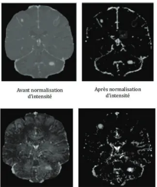 Figure 7 : Images de différences de contraste en IRM  après rehaussement en Gd (haut) et USPIO (bas), avec  (gauche) ou sans (droite) normalisation d’intensité