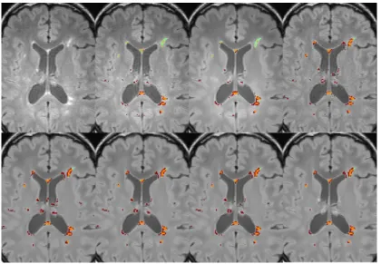 Fig. 2. Comparison of results for subject 3: From left to right, and from top to bot- bot-tom: FLAIR sequence, Basic(v1), NLM(v1), IIH(v1), IIH+NLM(v1), NLM+IIH(v1), NLM+IIH(v1.5), NLM+IIH(v2)