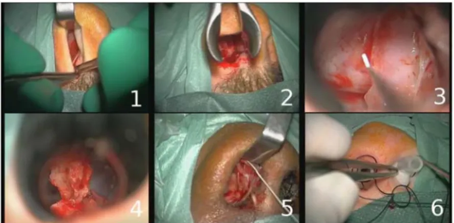 Fig. 1. Example of typical digital microscope images for the six phases: 1) nasal incision, 2)  nose retractors installation, 3) access to the tumor along with tumor removal, 4) column of nose  replacement, 5) suturing, 6) nose compress installation.