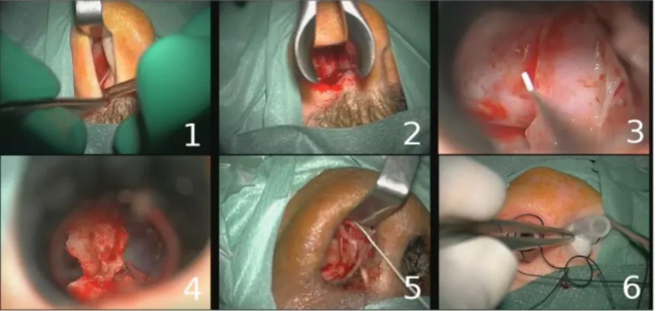 Fig. 1. Example of typical digital  microscope images for the six phases: 1) nasal incision, 2)  nose retractors installation, 3) access to the tumor along with tumor removal, 4) column of nose  replacement, 5) suturing, 6) nose compress installation