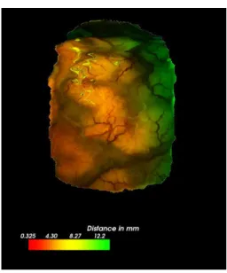 Figure 5: Results: Reconstructed surface of the dura mater superim- superim-posed to the preoperative MRI using the image-to-patient registration matrix computed by the neuronavigation system