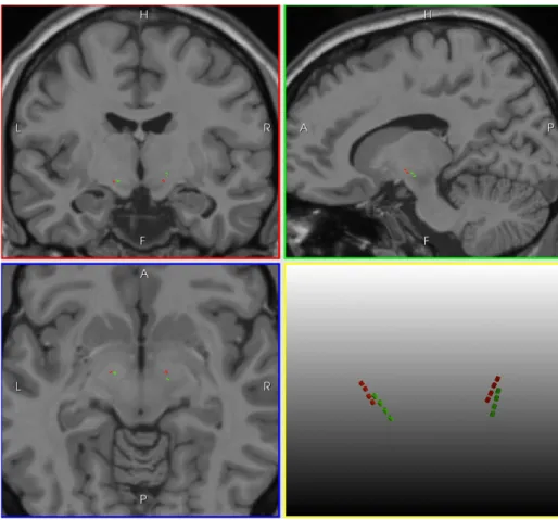 Fig 4: Representation of four electrodes (implanted in the STN) from two patients in the Colin27 space after registration.