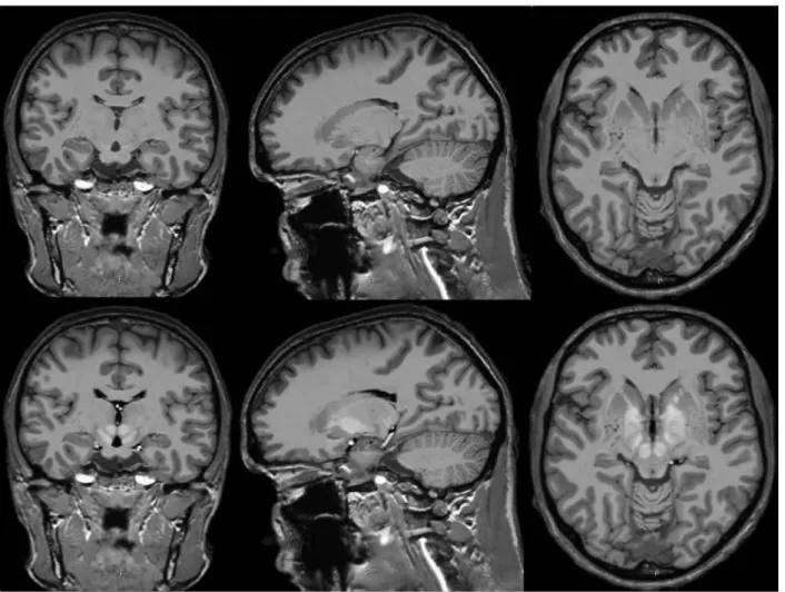 Figure 1. Coronal, sagittal and axial slices of the T1 (above) and the T1-T2 mixed (below) templates