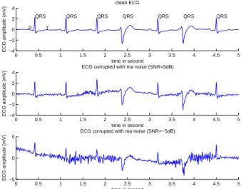 Fig. 1. Haut: ECG avec transition d’un rythme normal  (0-2s) à un rythme bigéminisé  (2-5s)
