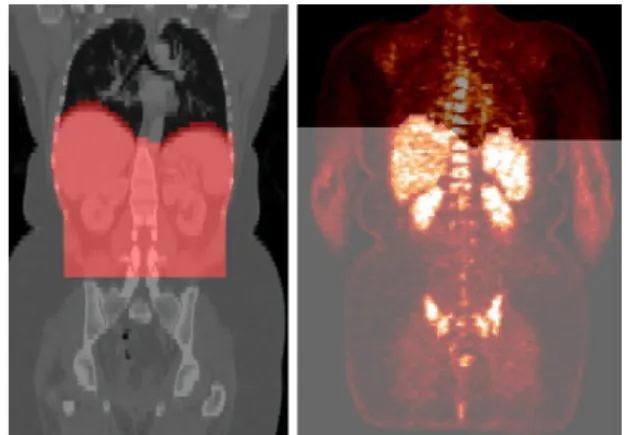 Figure 1: ROI used for the segmentation of the kidneys (brighter area). Left: CT image