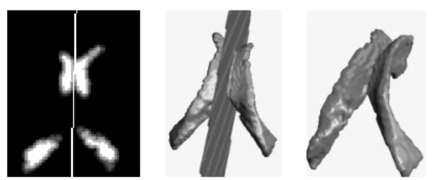 Figure 4 shows the symmetry plane found by this method. The image is a fuzzy  segmen-tation of the lateral ventricles in an MR  im-age