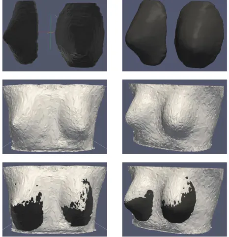 Figure 9. Breasts segmentation for subjects 15 and 20. Top images are the experts segmentations.
