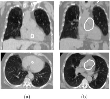 Fig. 8. Coronal and axial views of some results of heart segmentation. The contours, superimposed on the CT image, have been calculated: (a) using only the GVF force, which is not sufficient at all; and (b) using the GVF and a pressure force weighted with 