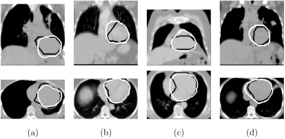 Fig. 11. Manual (black) and automatic (white) segmentations of the heart using our method for patients illustrated in Figures 5(b-e).