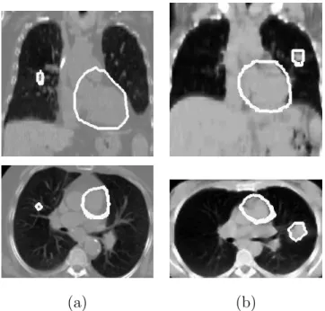 Fig. 12. Results of automatic heart segmentation for two cases where a tumor is present in the right (a) and in the left lung (b)