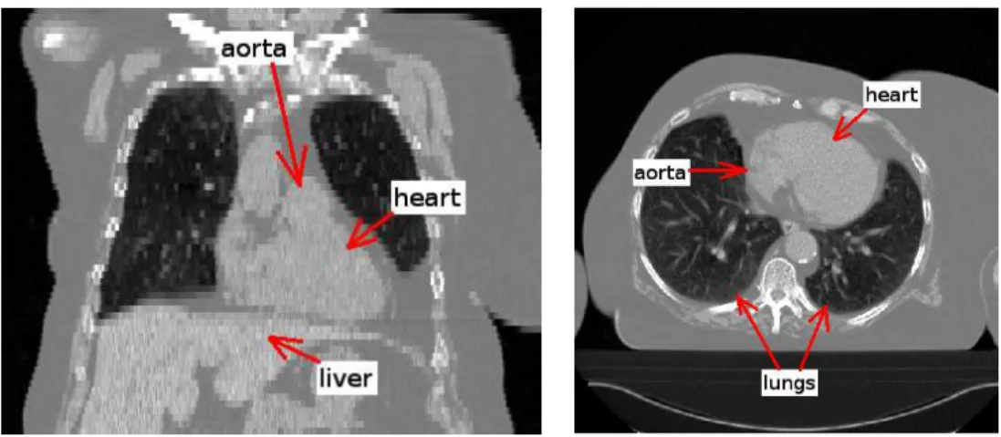 Fig. 1. Coronal (left) and axial (right) views of a CT image.