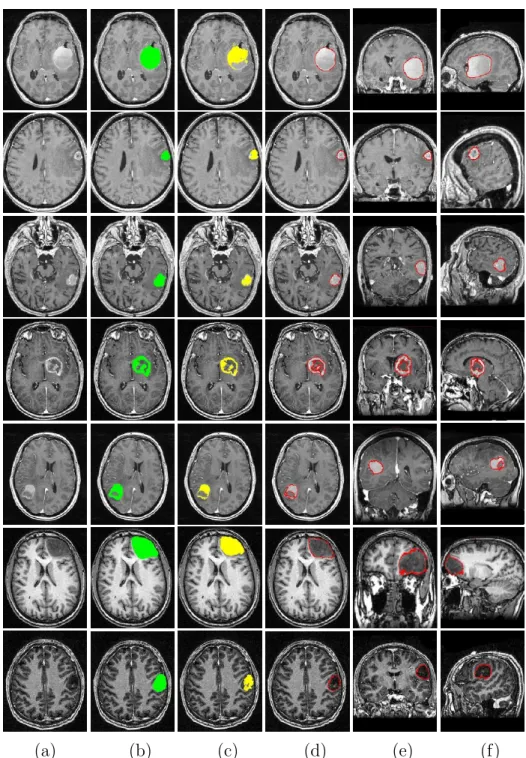 Fig. 13. Comparison of manual and automatic segmentation results using symme- symme-try analysis and constrained deformable model for 7 different cases