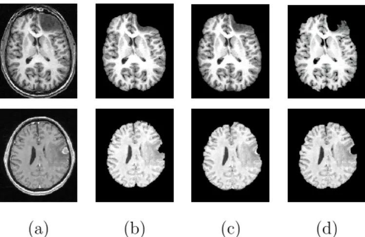 Fig. 2. Pathological brain segmentation using existing methods. (a) One slice of the original image on two examples