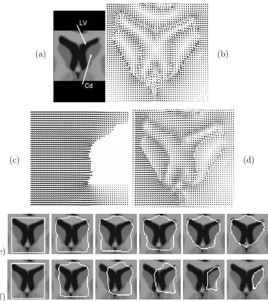 Fig. 4. Basic example of deformable model driven by spatial relations. (a) The image is a portion of a simulated brain MRI and shows the lateral ventricles (LV) and the caudate nuclei (Cd)