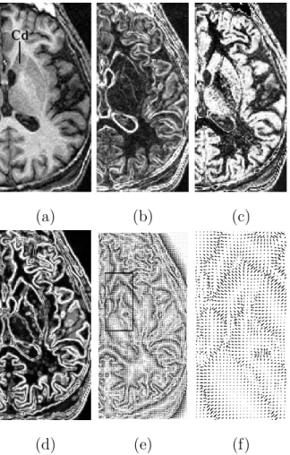 Fig. 5. Edge map for the caudate nucleus (axial slices): (a) original image (the cau- cau-date nucleus is indicated by the label “Cd”), (b) gradient computed on the original image, (c) probability map, (d) edge map: gradient computed on the probability map
