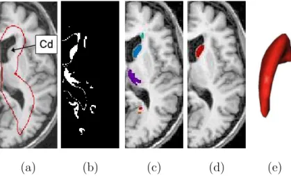 Fig. 6. Initialization for the caudate nucleus (axial slices): (a) kernel of the Region Of Interest (contour in red) superimposed on the MRI (the caudate is indicated by the arrow); (b) automatic thresholding in the Region Of Interest; (c) separation of ob