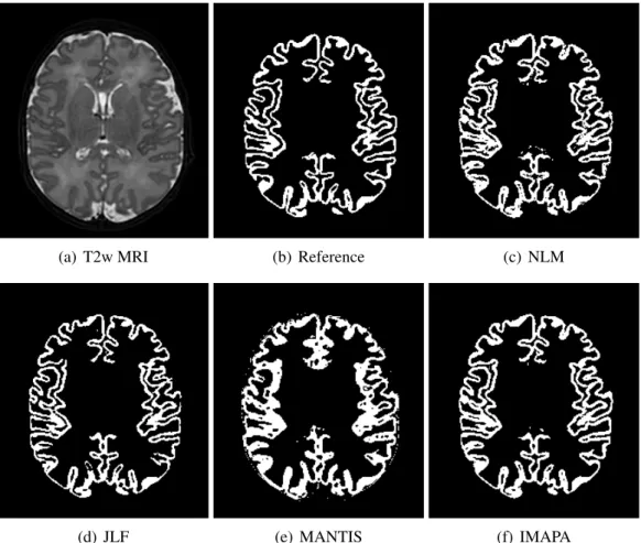 Figure 2: Segmentation results on a T2-weighted brain MRI (axial slice). (a) Input image