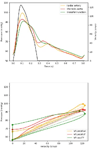 Figure 3 : Example of velocity, radial, thoracic and transformed radial waveforms in upper panel and  their respective VP Loops in lower in an low risk patient 