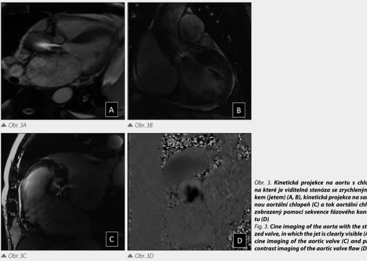 Fig. 3. Cine imaging of the aorta with the steno- steno-zed valve, in which the jet is clearly visible (A, B),  cine imaging of the aortic valve (C) and phase  contrast imaging of the aortic valve flow (D) 