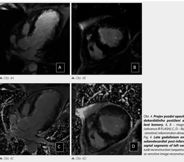 Fig. 4. Late gadolinium enhancement (LGE) in  subendocardial post-infarction scar in  antero-septal segments of left ventricle