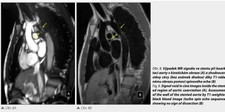 Fig. 9. Contrast-enhanced MR angiography  (CE-MRA) showing left upper pulmonary vein  entering superior vena cava in partial  anoma-lous pulmonary venous drainage (PAPVD)