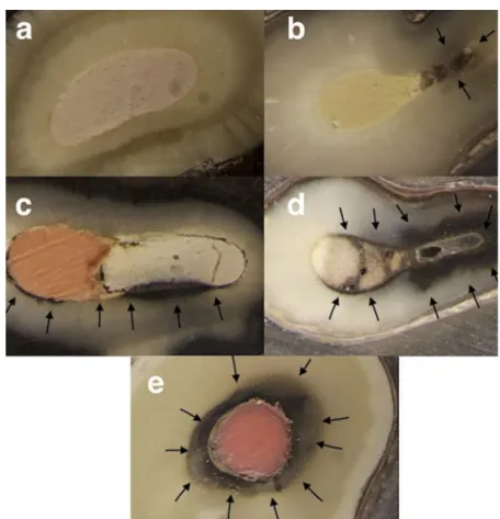 Figure 2 Scores of the dye test. (a) Score 0: Absence of leakage. (b) score 1: &lt;25% of canal circumference were concerned by the leakage of silver nitrate