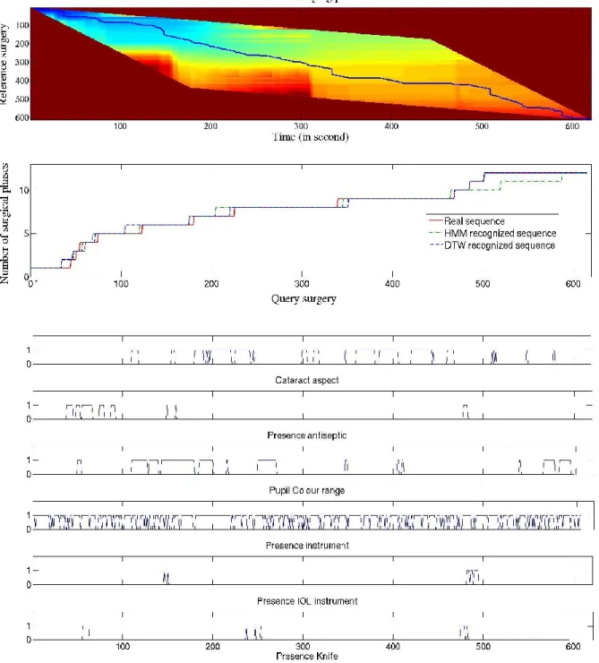 Fig. 8. Distance map of two surgeries and dedicated warping path using the Itakura constraint (up), along with transposition of the surgical  phases (middle), and the visual cues detected by the system (down)