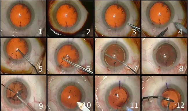 Fig.  6.  Typical  digital  microscope  frames  for  the  12  surgical  phases:  1-preparation,  2-betadine  injection,  3-lateral  corneal  incision,  4- 4-principal corneal incision, 5-viscoelastic injection, 6-capsulorhexis, 7-phacoemulsification, 8-cor