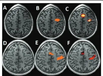Figure 1 Task-related activation zones of two patients. A, D. T1 image. B, E. SPM detection