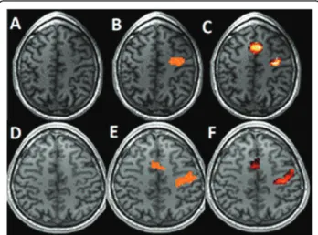 Figure 1 Task-related activation zones of two patients. A, D. T1 image. B, E. SPM detection