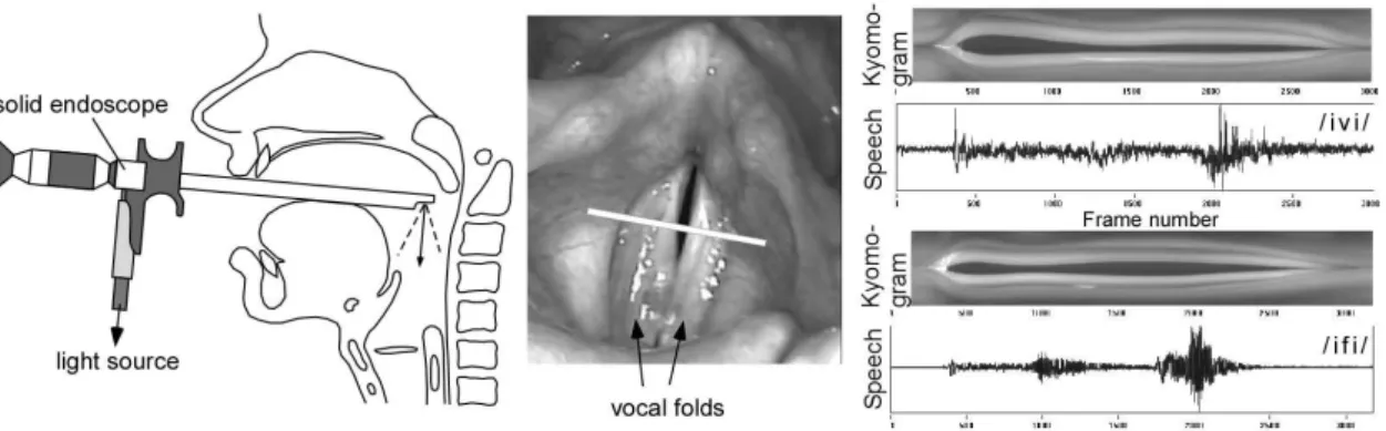 Figure  6  illustrates  the  endoscope  placement,  acoustic  signal,  and  the  corresponding  videokymographic 10   data  for  the  sequences  /ivi/  and  /ifi/  produced  in  whispering
