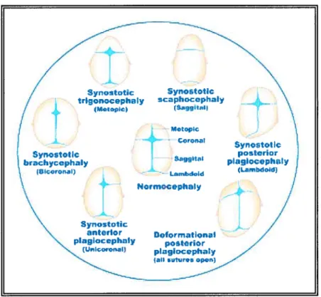 Figure 2 Morphologies retrouvées selon l’endroit dc la synostose.