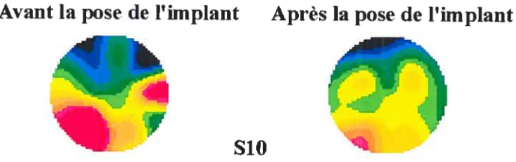 Figure 4: activation cérébrale à 230 ms après la transformation du stimulus CCR chez deux sujets sourds (S10 et S3) avant (à gauche) et après (à droite) la pose de l’implant cochléaire.