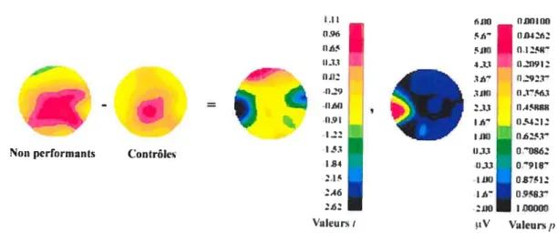 Figure 5 : activation cérébrale à 230 ms après la transformation du stimulus CCR chez quatre sujets sourds (S8, S9, S10 et Su)  non-performants montrant une latéralisation à gauche par rapport aux sujets contrôles