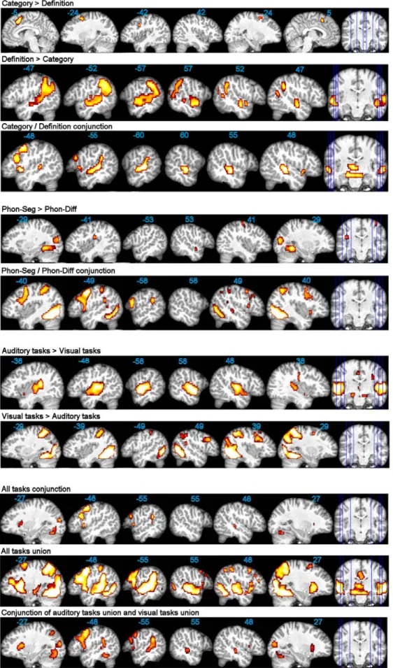 Fig. 2. Task comparisons, conjunctions, and union (p&lt;0.001 unc.). Functional maps are superimposed onto an  individual brain normalized with respect to our customized pediatric template, with x-coordinates in MNI space