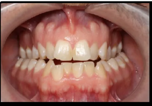 Figure 3. Bilateral Posterior Crossbite (Photo by Dr P. Ross Fiore) 