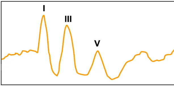 Figure 5: Tracé du PAE d’un poulain normal avec une fusion des ondes IV et V. Oreille  gauche, 11,33 Hz/70 dBNHL 