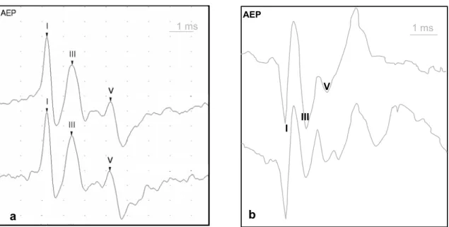 Figure 6: Représentation de 2 tracés de PAE de polarités différentes. a) Polarité positive  du tracé