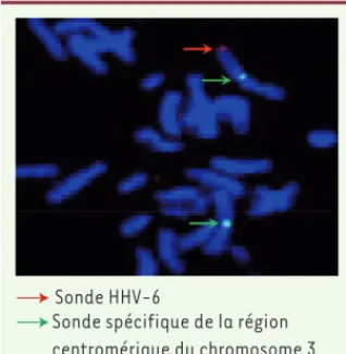 Figure 1. Détection du génome du HHV-6 inté- inté-gré au génome humain par hybridation in situ  en fluorescence