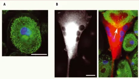 Figure 2. Modification de l’organisation des podosomes des macrophages par le VIH-1. Images  d’immunofluorescence de macrophages humains non infectés (A)  et infectés par le VIH-1 (B)