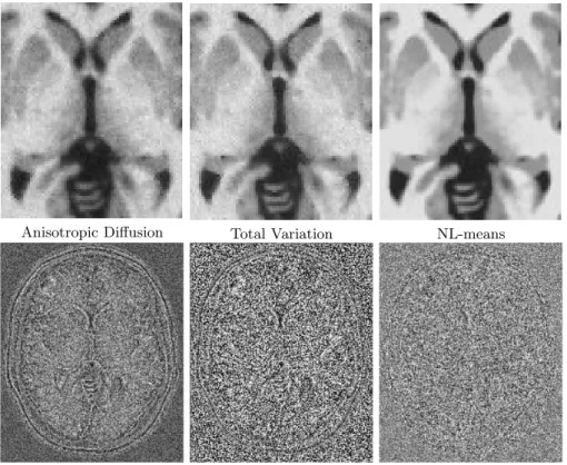 Fig. 4. Top: details of the Brainweb denoised images obtained via the three compared methods for a noise level of 9%