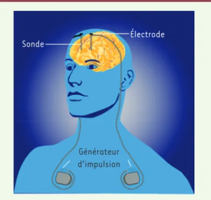 Figure 1.  Mise en place de la stimulation cérébrale profonde  chez l’homme (© Creative commons Wikimedia).