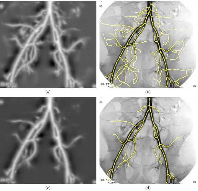 Figure 5. Eﬀect of changing the smoothing weight on Iliac Image (2) for the medialness and the centerline