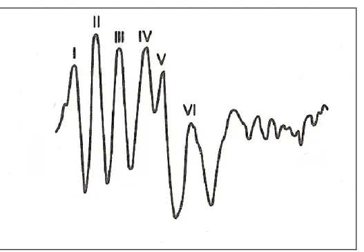 Figure 2 – Normal human BAER tracing demonstrating the presence of 6 peaks. Note  the presence of wave IV as distinct from wave V