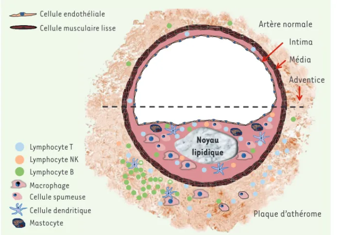 Figure 1. Cellules immunitaires dans une  artère normale ou pathologique. Le délai de  constitution des lésions d’athérome est long  (des décénnies chez l’homme) et la structure  de ces lésions varie avec le temps