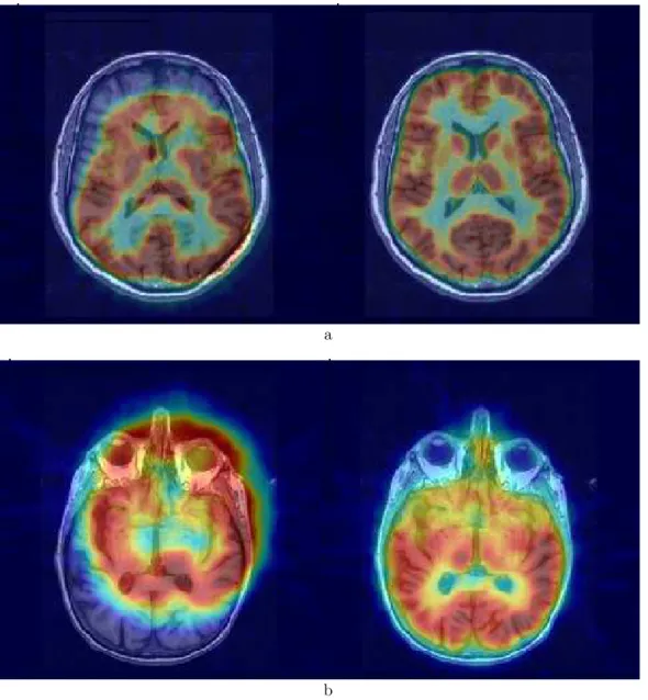 Figure 6. Registration results on real data. a) PET-to-MRI registration. b) SPECT-to-MRI registration