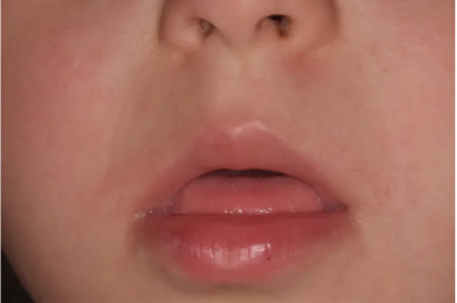 Figure 2.  Position protrusive de la langue au repos chez une patiente atteinte de T21 