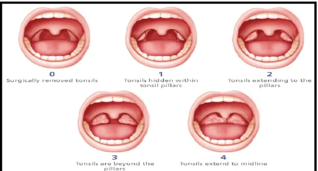 Figure 9: Tonsillar grading(80) 